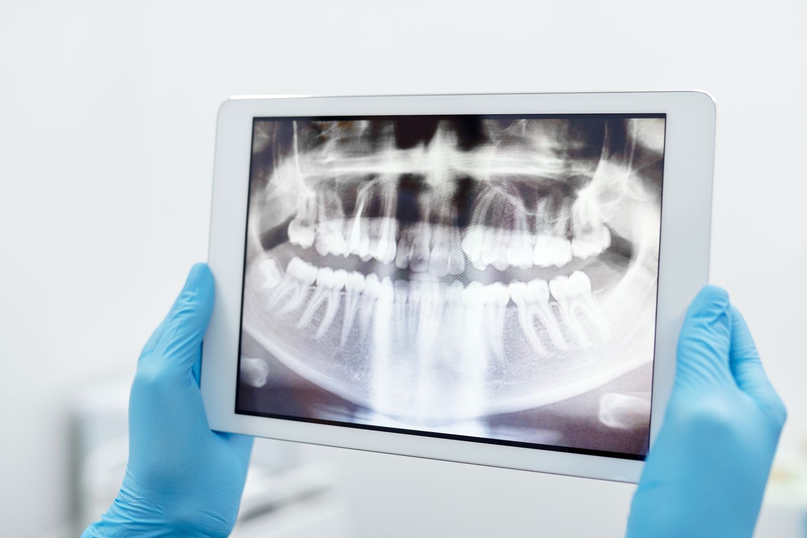 Gloved hands holding a tablet that displays a panoramic dental X-ray of the upper and lower jaw.