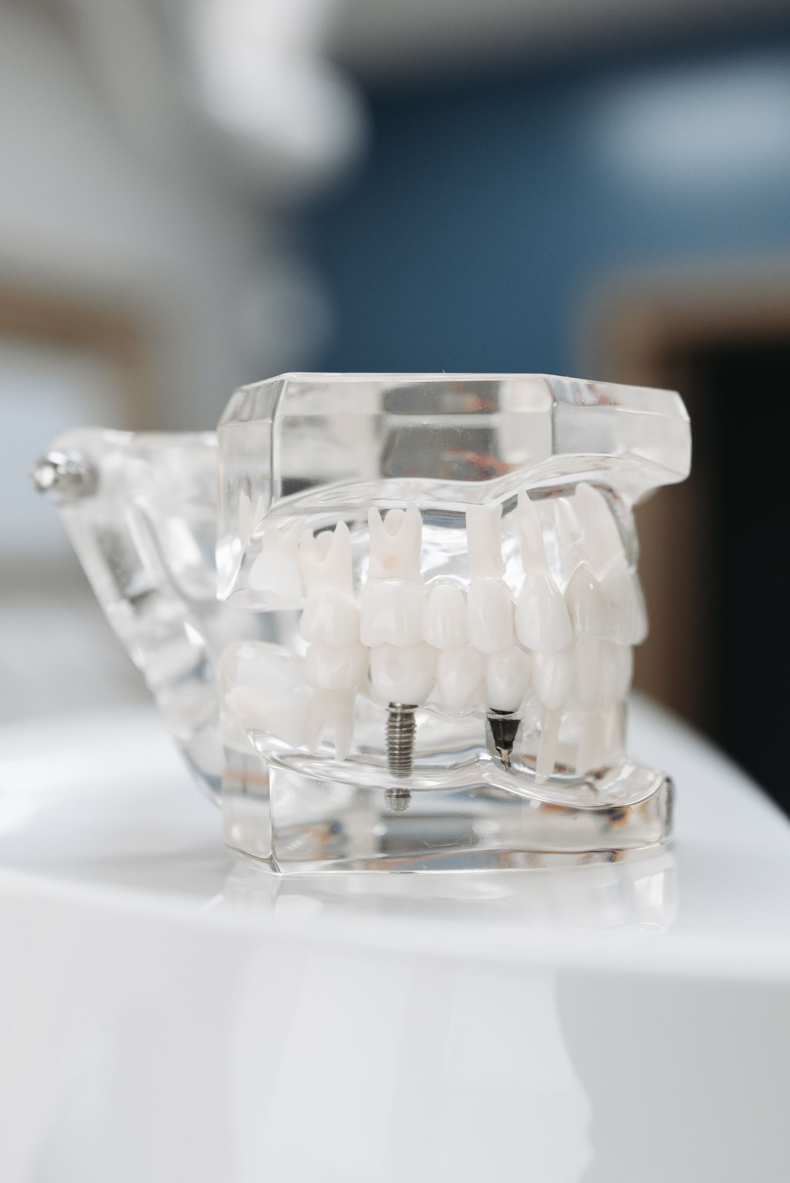 A transparent dental jaw model showing two titanium implant screws.